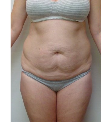 abdominoplasty front view before